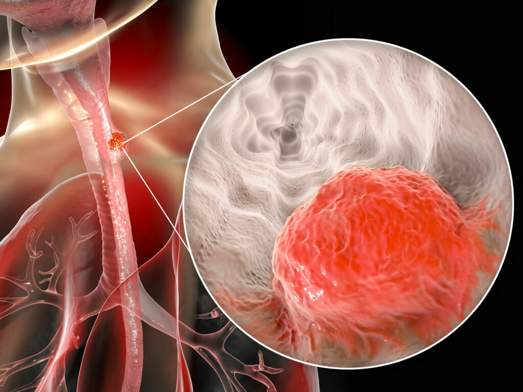 blog-esophageal-cancer-ss-1476704297-1024×768