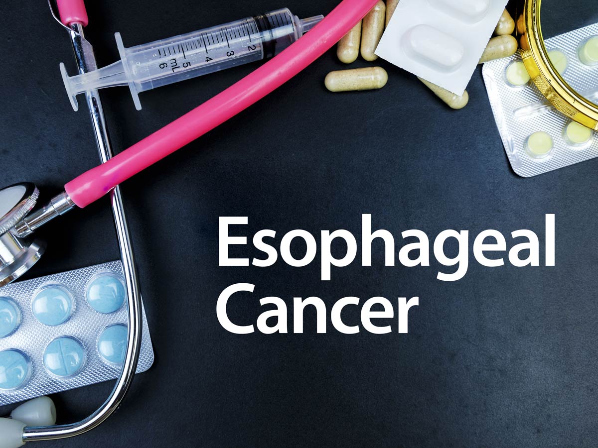 blog-esophageal-cancer-ss-599136104