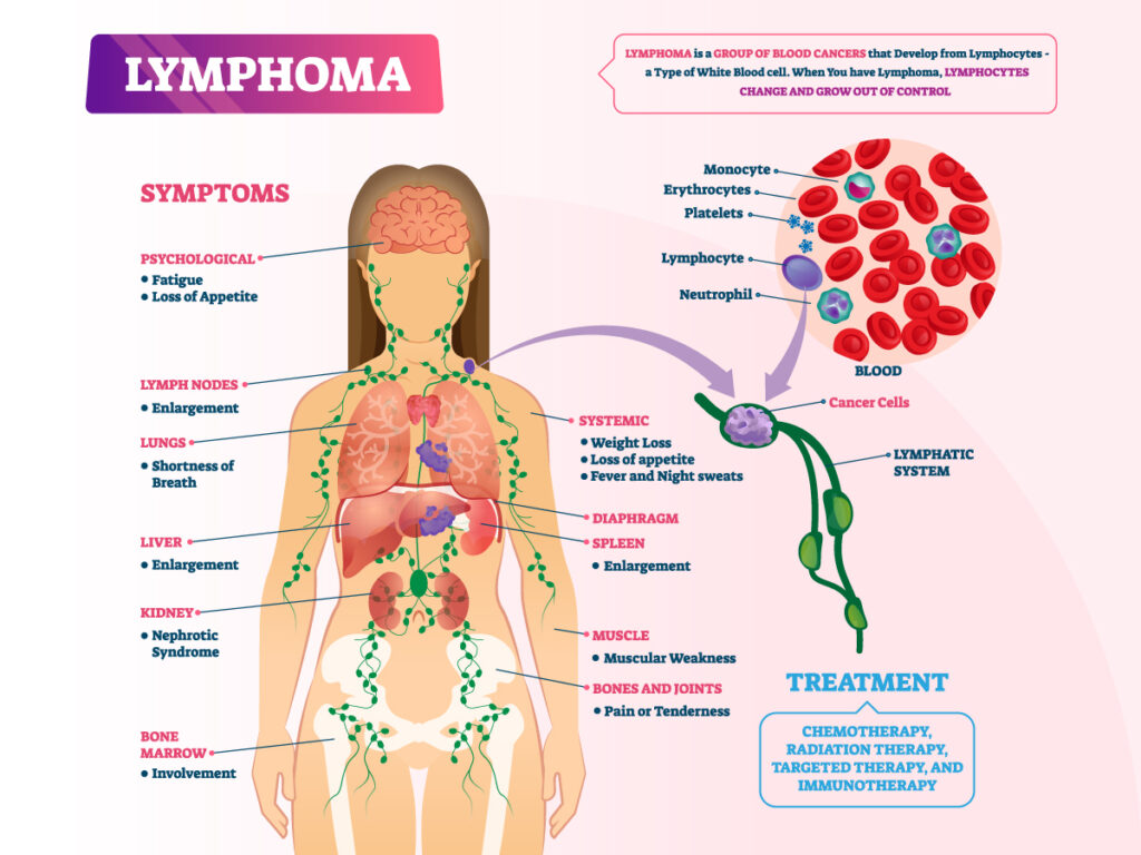 blog-lymphoma-illustrated-ss-1455195890-1024×768