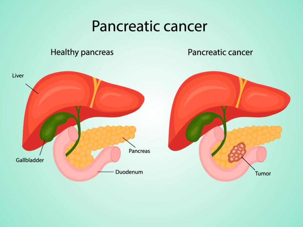 blog-pancreatic-cancer-illustration-ss-1951730341-1024×768