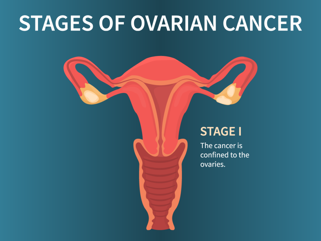 blog-stages-ovarian-cancer-ss-1712984437-01-1024×768