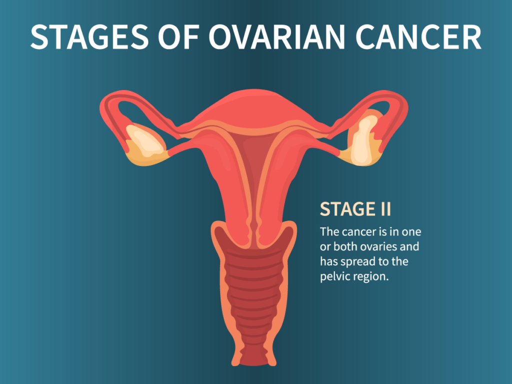 blog-stages-ovarian-cancer-ss-1712984437-02-1024×768