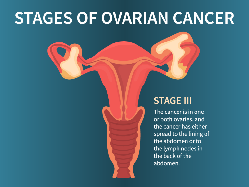 blog-stages-ovarian-cancer-ss-1712984437-03-1024×768