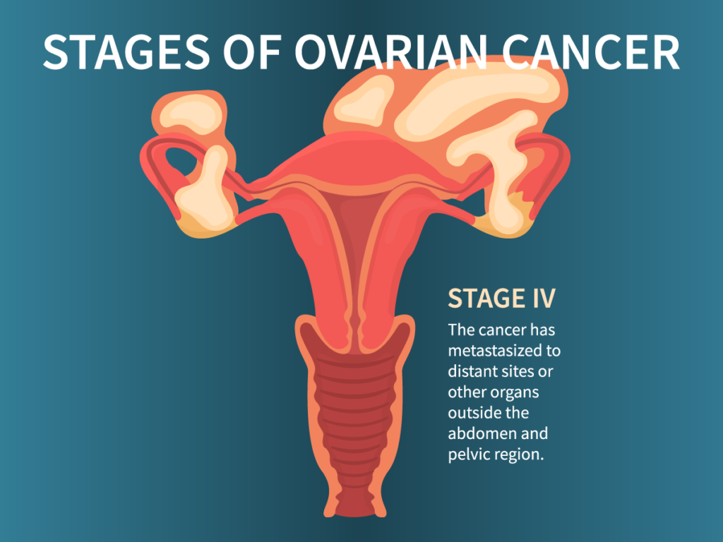blog-stages-ovarian-cancer-ss-1712984437-04-1024×768