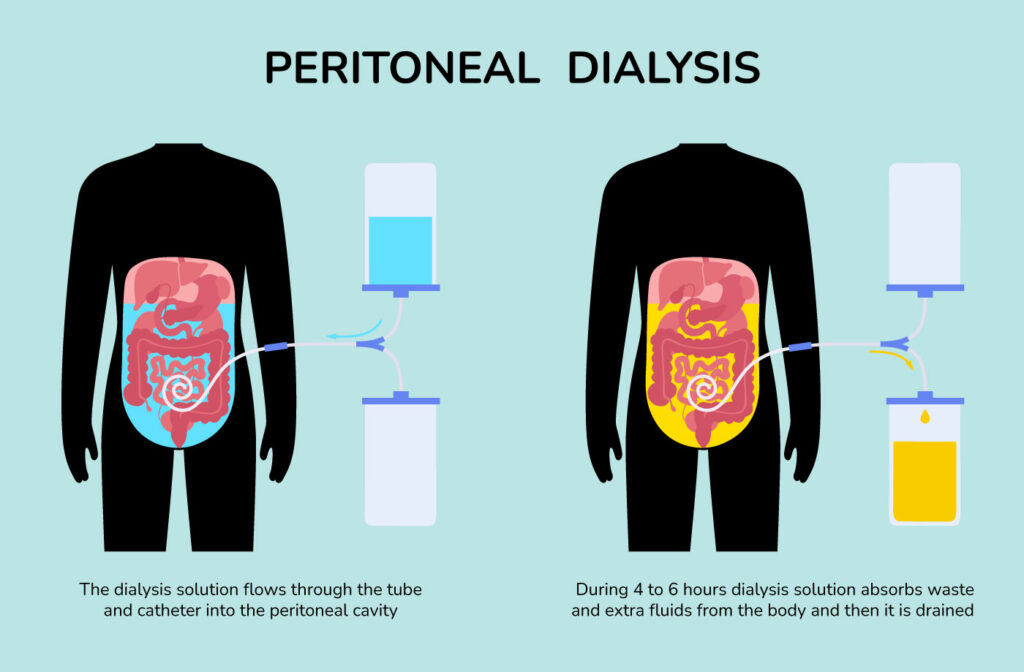 peritoneal-dialysis-illustration-rgb-1-1024×672